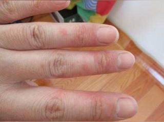 脚上起小水泡还很痒？别忽视，这可能是身体在发出警报