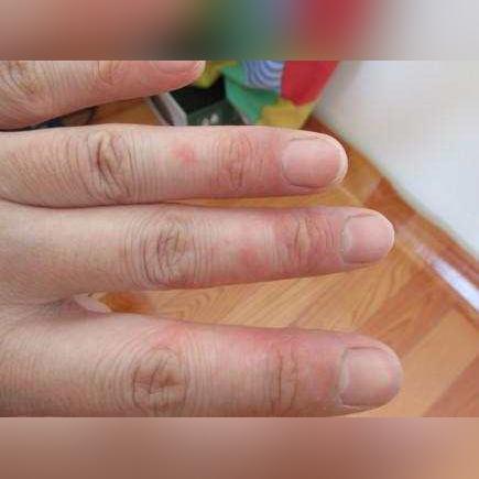 脚上起小水泡还很痒？别忽视，这可能是身体在发出警报